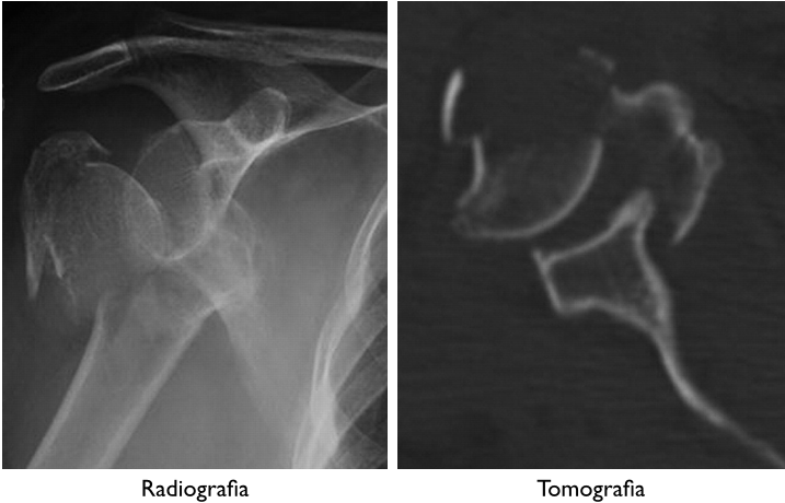 Uma radiografia de um ombro e uma tomografia do mesmo ombro