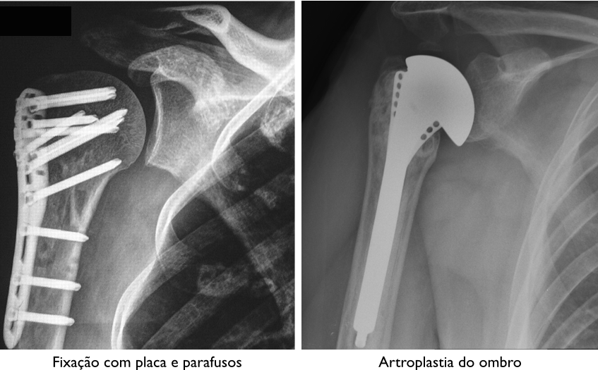 Uma radiografia do ombro de uma pessoa com uma placa