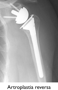 Uma radiografia do ombro de uma pessoa com uma prótese articular.