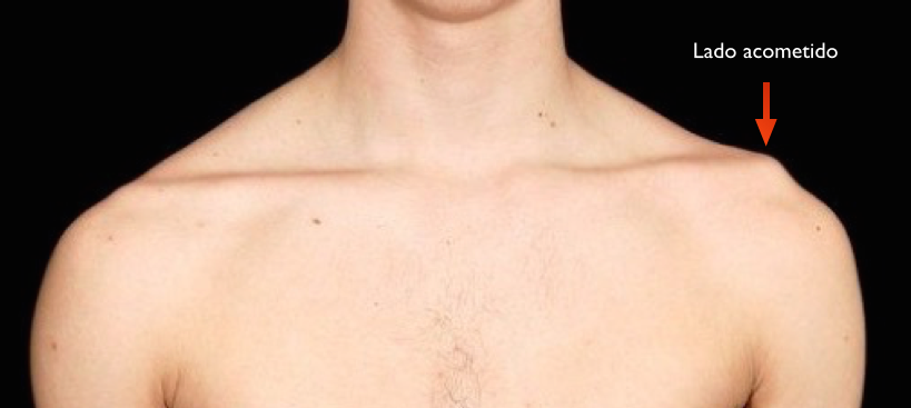 Um homem sem camisa é mostrado com uma seta apontando para seu ombro.