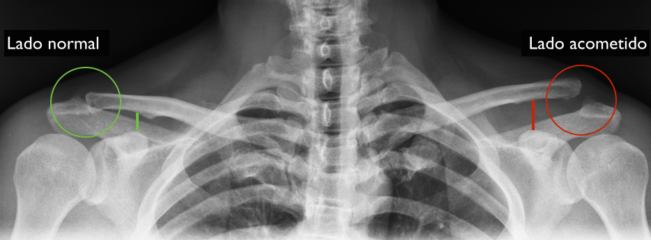 Uma radiografia do ombro de uma pessoa mostrando um ombro normal e um ombro quebrado.