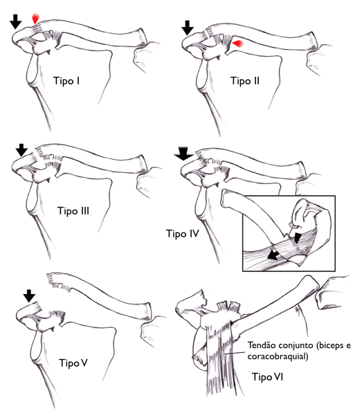 Um desenho de um ombro com diferentes tipos de tensões