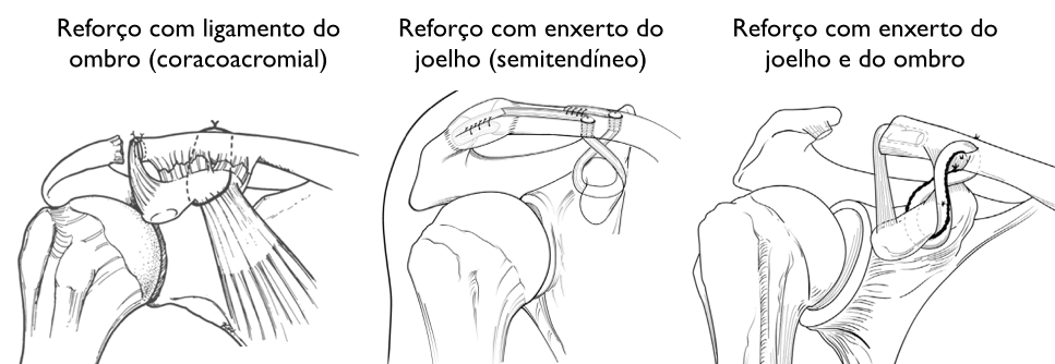 Um desenho em preto e branco de três tipos diferentes de articulações dos ombros.