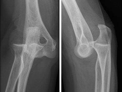Duas radiografias do cotovelo de uma pessoa mostrando os ossos do cotovelo.