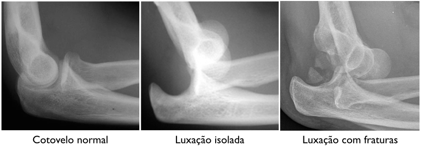 Três tipos diferentes de radiografias do cotovelo são mostrados