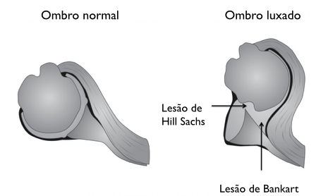 Um diagrama de uma articulação do ombro normal e luxada