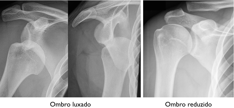 Três tipos diferentes de radiografias do ombro são mostrados