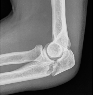 Uma radiografia do cotovelo de uma pessoa mostra uma articulação do cotovelo quebrada.