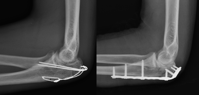 Uma radiografia do cotovelo de uma pessoa com um parafuso.