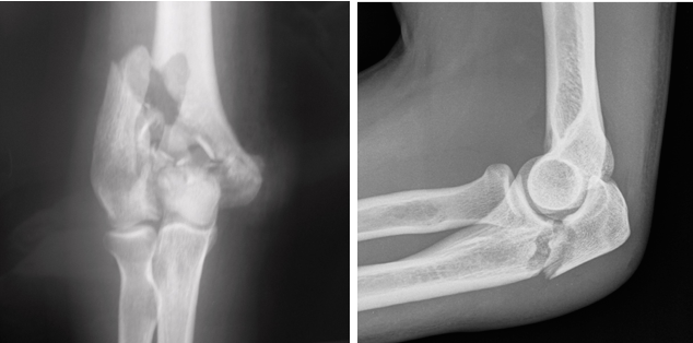 Duas radiografias do cotovelo e do joelho de uma pessoa.
