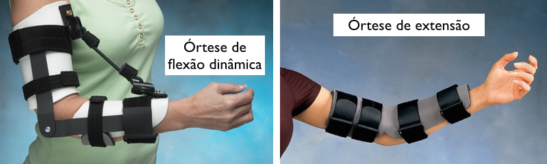 Uma mulher está usando uma cinta no cotovelo e outra pessoa está usando uma cinta no braço.
