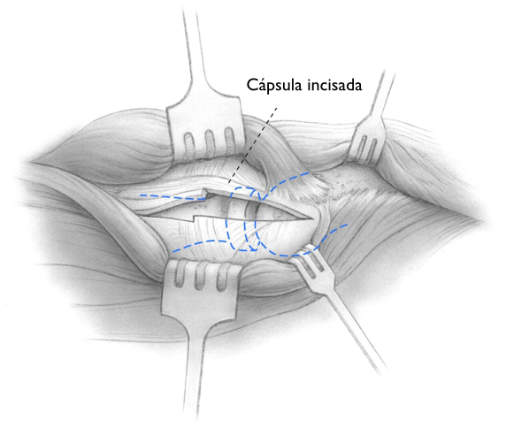 Um desenho em preto e branco de um procedimento cirúrgico chamado cápsula incisada