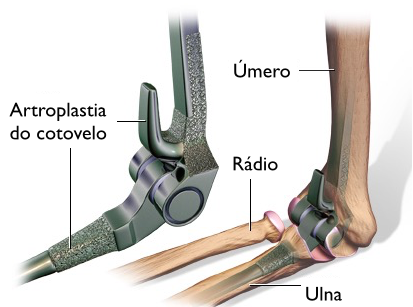 Um diagrama de um cotovelo com rádio e ulna