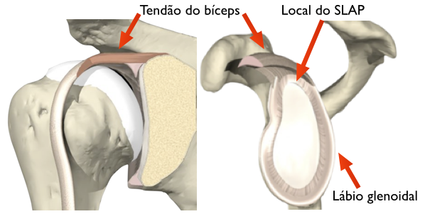 Um diagrama de um ombro mostrando o tendão do bíceps e o local do tapa