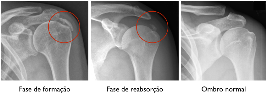 Três radiografias de um ombro mostrando diferentes estágios de recuperação.