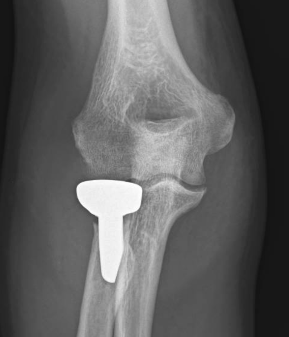Uma radiografia do cotovelo de uma pessoa com um parafuso.