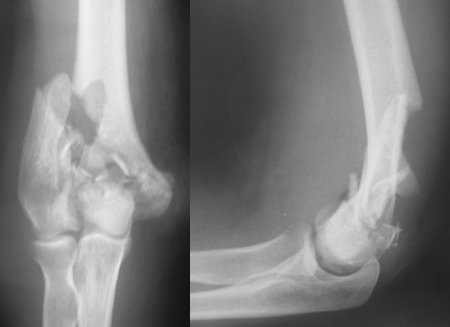 Uma radiografia em preto e branco do cotovelo de uma pessoa mostrando um osso quebrado.