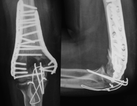 Uma radiografia do cotovelo de uma pessoa com um parafuso.