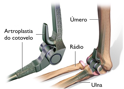 Um diagrama de um cotovelo com uma radiografia mostrando os ossos e um dispositivo cirúrgico.
