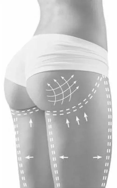 Cirugía de gluteos