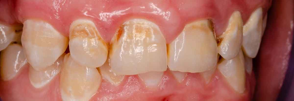 Tooth Decay
