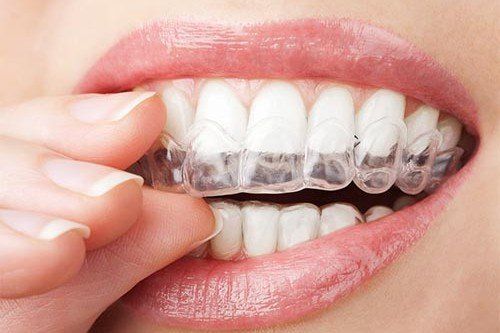 a woman is putting a clear brace on her teeth .
