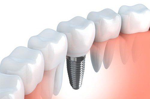 a computer generated image of a dental implant in a row of teeth .