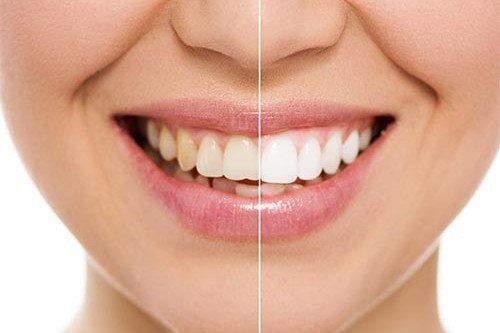 A close up of a woman 's teeth before and after whitening.