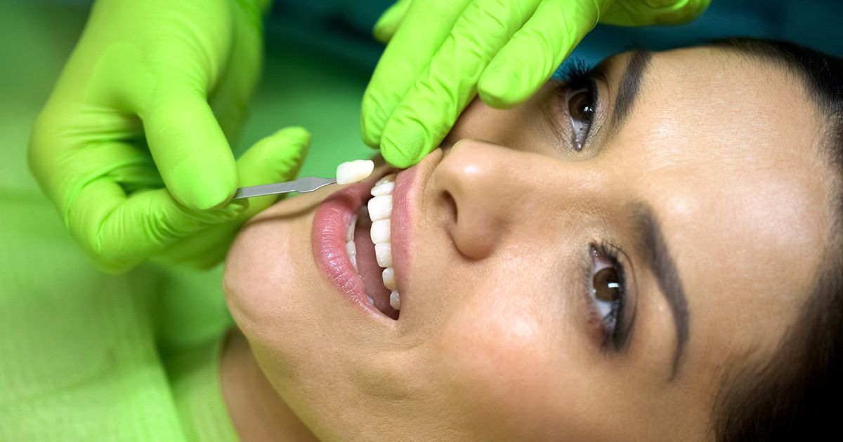 porcelain dental veneers