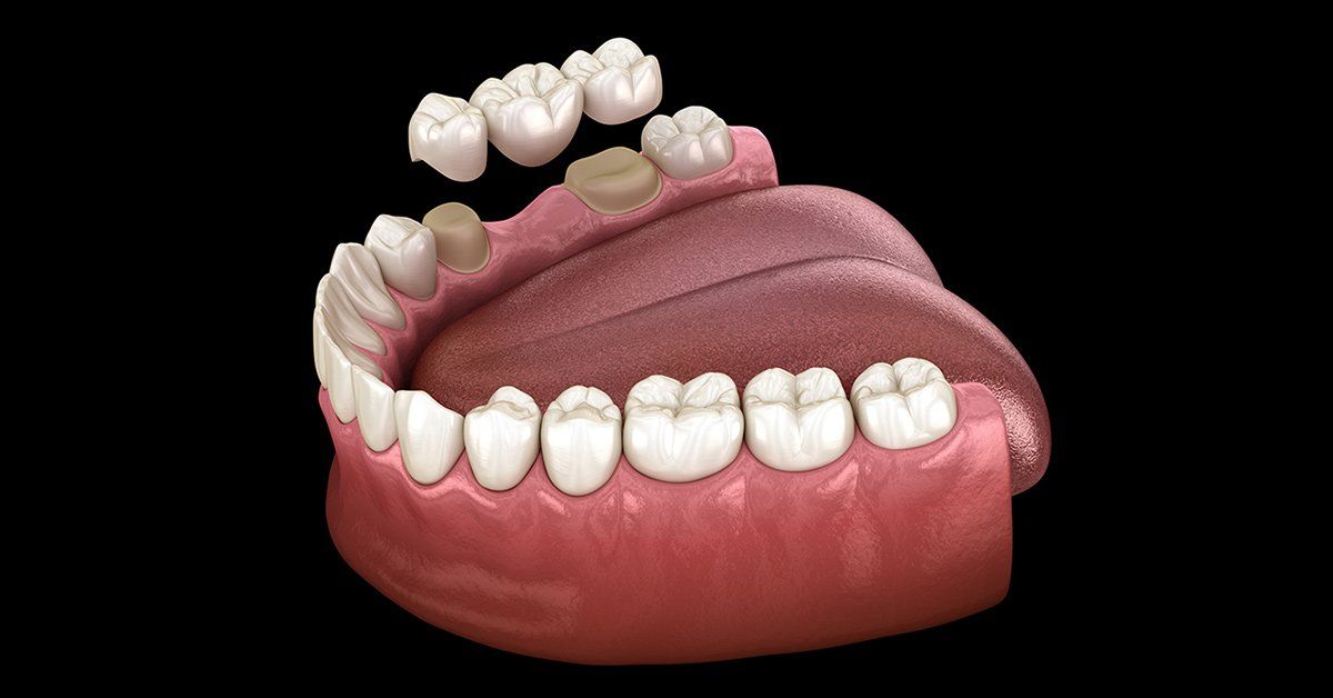 dental bridge