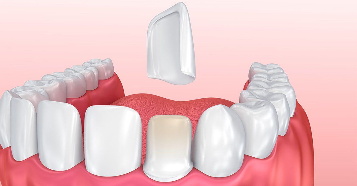 porcelain veneers