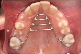 Palatal expander in a child's mouth, expanding the upper jaw.