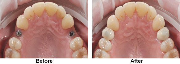Comparison of a mouth before and after orthodontic treatment; shows screws removed.