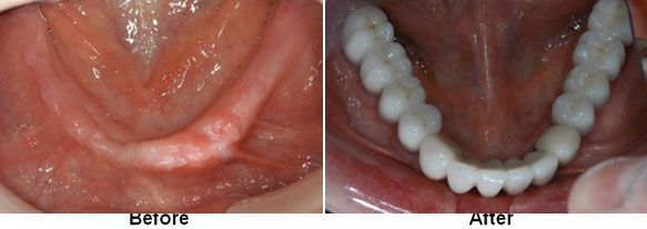 Dental before and after showing a jaw without teeth then with a full set of new teeth.