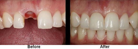 Before and after dental work: missing tooth replaced with a new tooth, resulting in a complete, white smile.