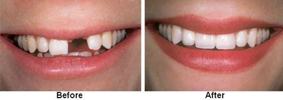 A comparison of teeth: before, a missing tooth; after, a complete smile with white teeth.