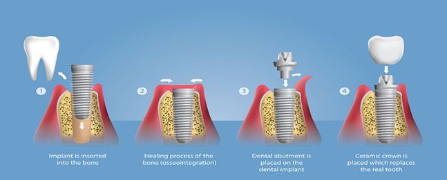 Dental implant procedure: step-by-step graphic. Stages include implanting, healing, attaching a post, and finally, placing a crown.