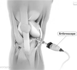 Kidney stone, urinary stone, ureteric stone, renal calculi, renal colic, nephrolithiasis