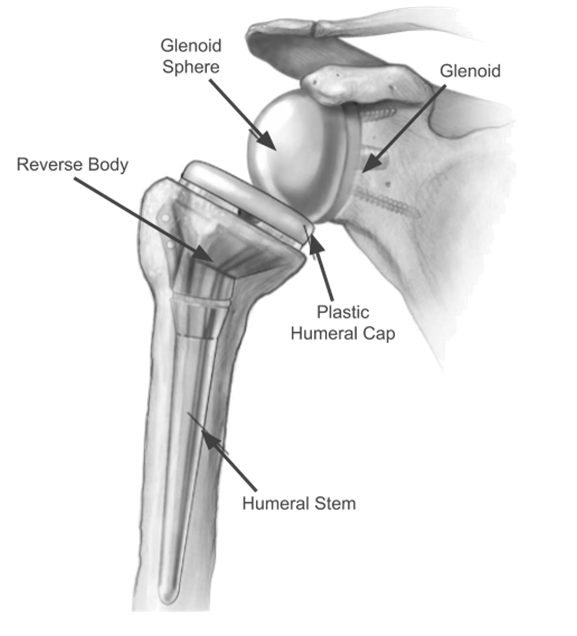 Kidney stone, urinary stone, ureteric stone, renal calculi, renal colic, nephrolithiasis