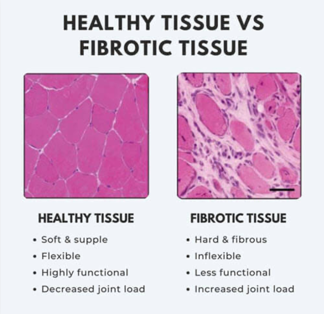 Healthy tissue vs fibrotic tissue histology comparison with labeled pink microscope images and bullet points