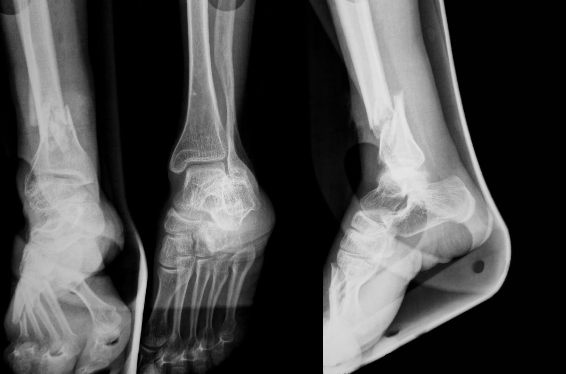 A pair of x-rays of a person 's ankle and foot.