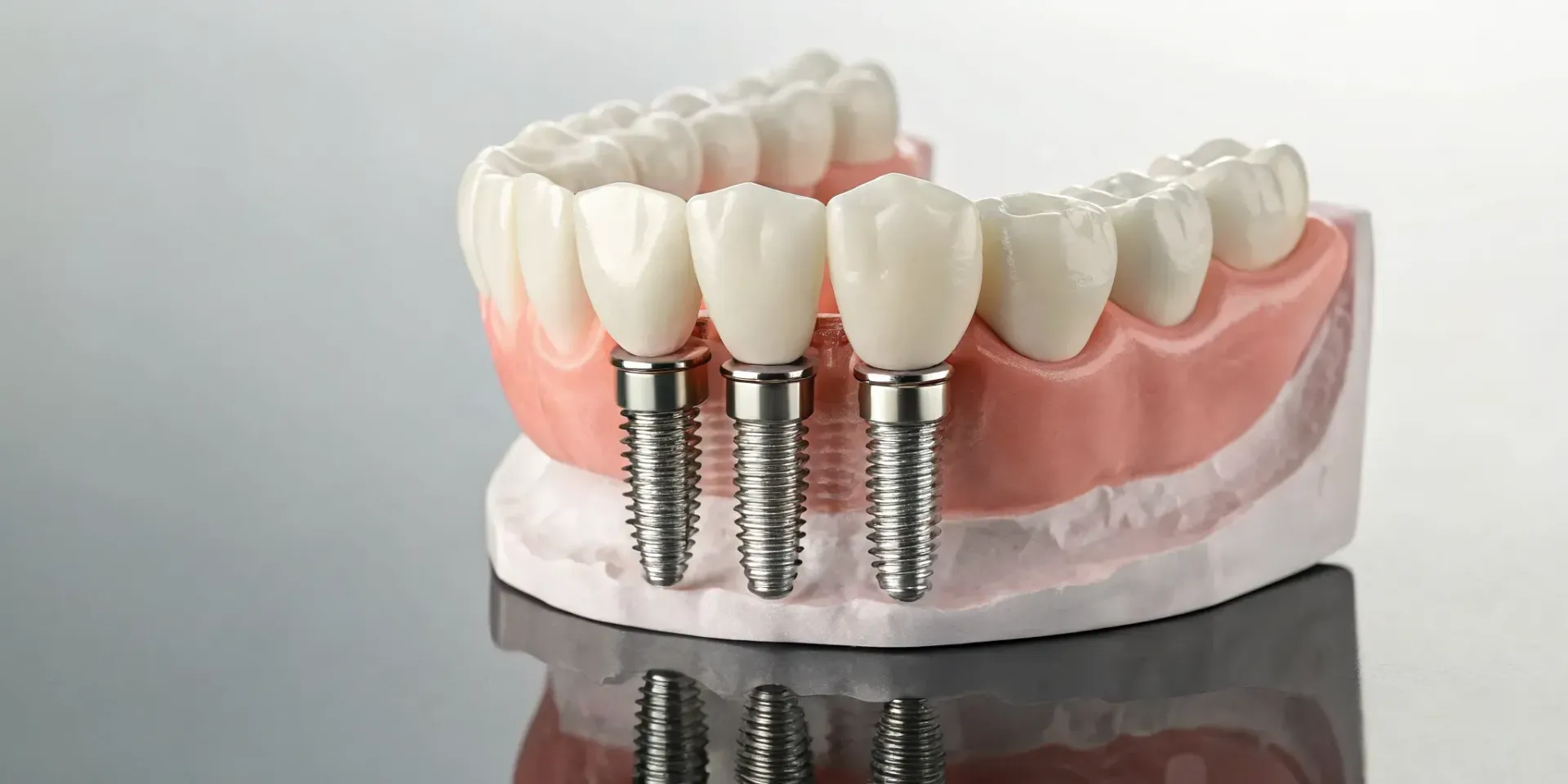 All-on-4 dental implants model with four posts supporting a full arch of teeth.