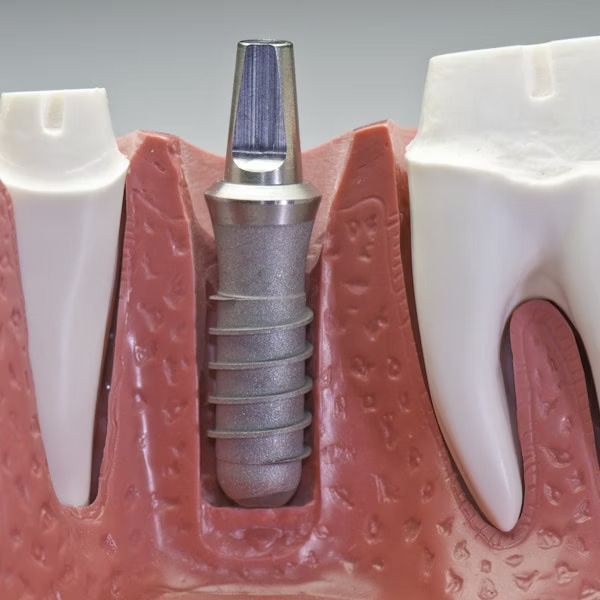A model of a tooth with a dental implant in it