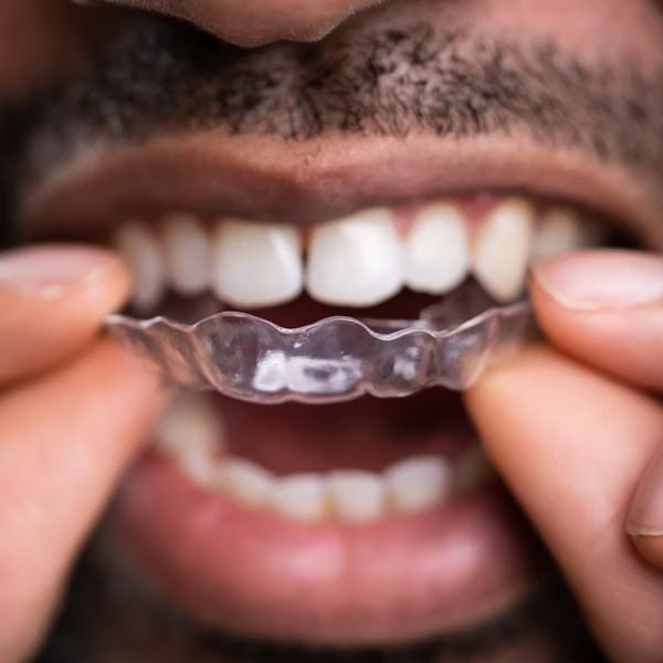 A man is putting a clear retainer on his teeth.