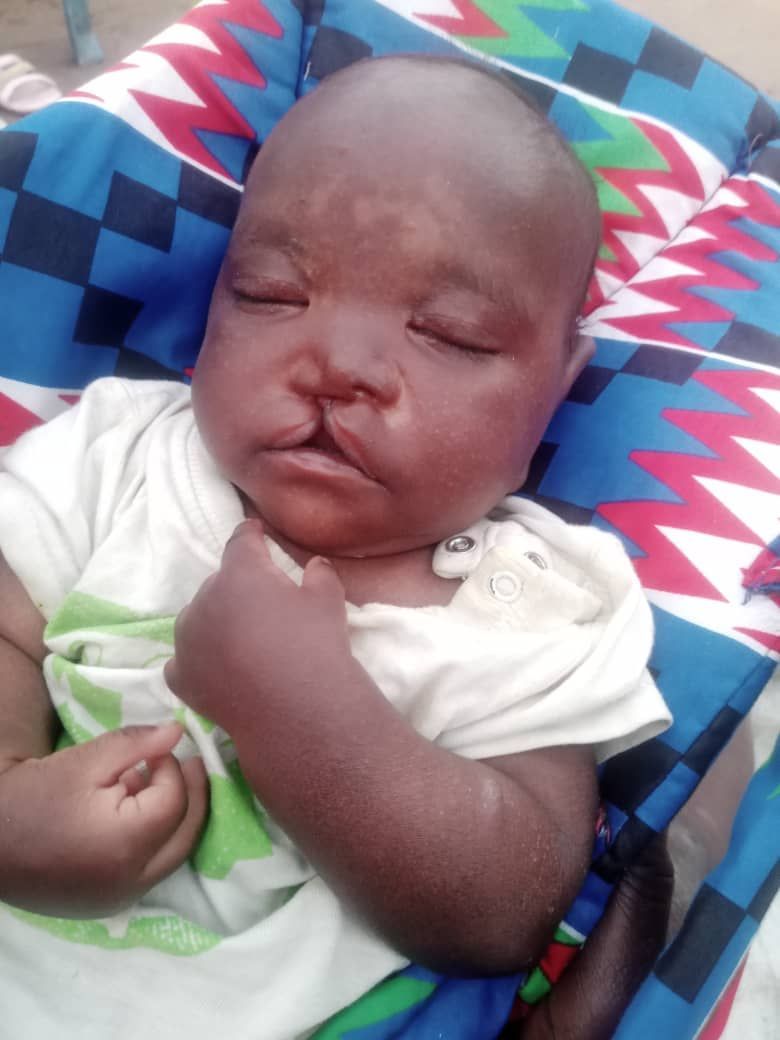 Baby with a cleft lip, dark skin, and closed eyes, lying on a patterned blanket.
