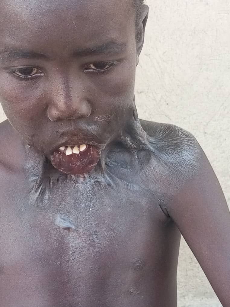 A child with severe, disfiguring scar tissue connecting their lower lip and chin to their left shoulder and chest.