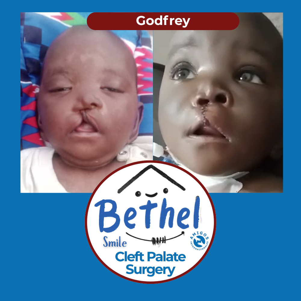 Before and after photos of a baby named Godfrey with cleft palate surgery logo