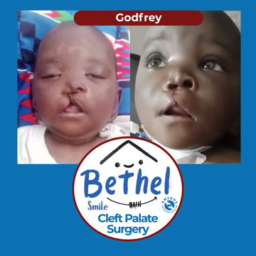 Before and after photos of a baby named Godfrey with cleft palate surgery logo