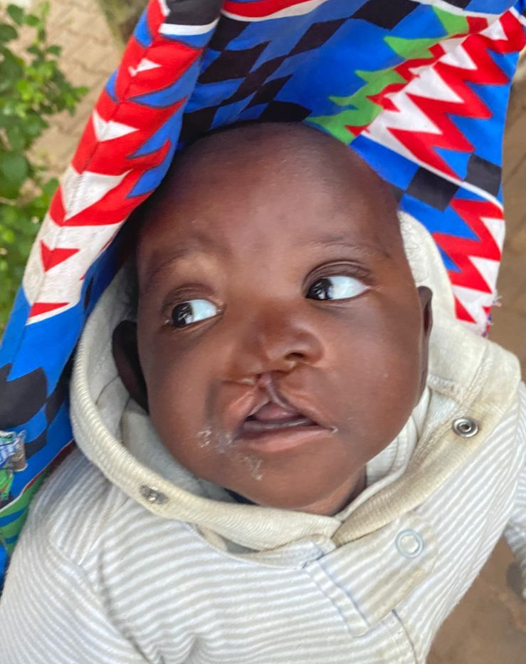Baby Godfrey with bilateral cleft lip before surgery, northern Uganda, September 2025
