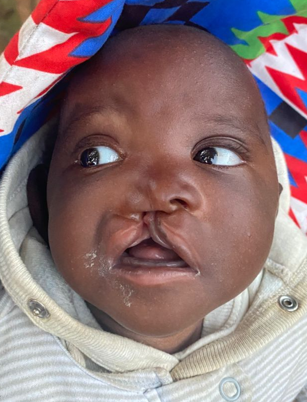 Baby with cleft lip looks upward, wrapped in patterned fabric.